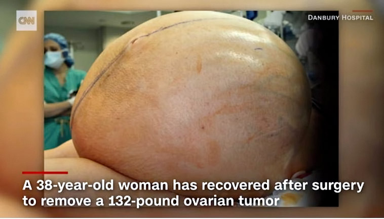 Surgeons remove 132lb tumor