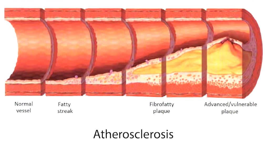 Common diuretic medication spironolactone (Aldactone) stops atherosclerosis